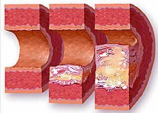 Stages of development of atherosclerotic plaques in people with hypertension